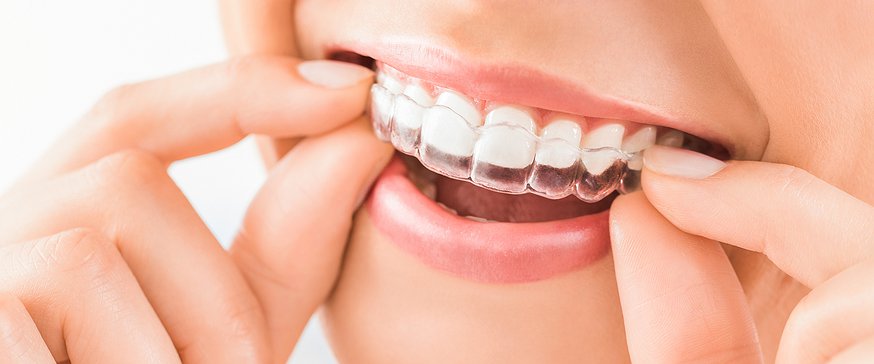 Teeth Whitening Service Dr. Dan Dental Beaumont AB