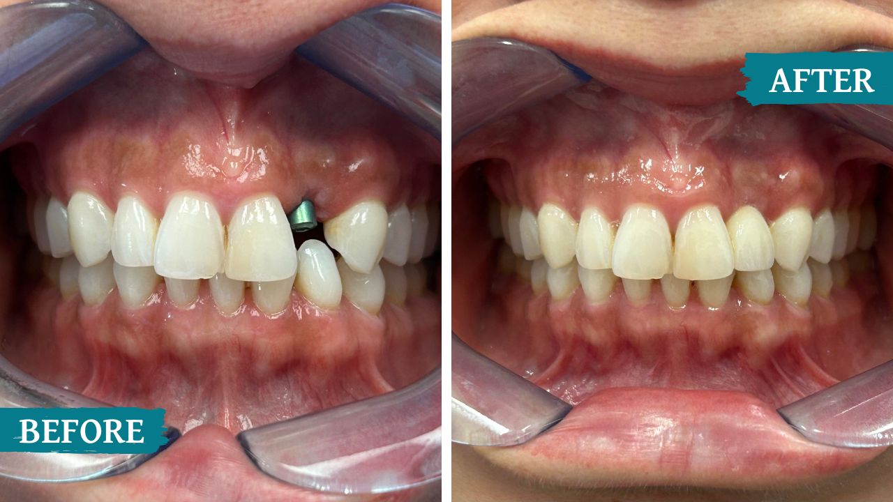 teeth before and after treatment