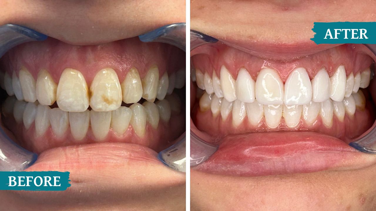 teeth before and after treatment